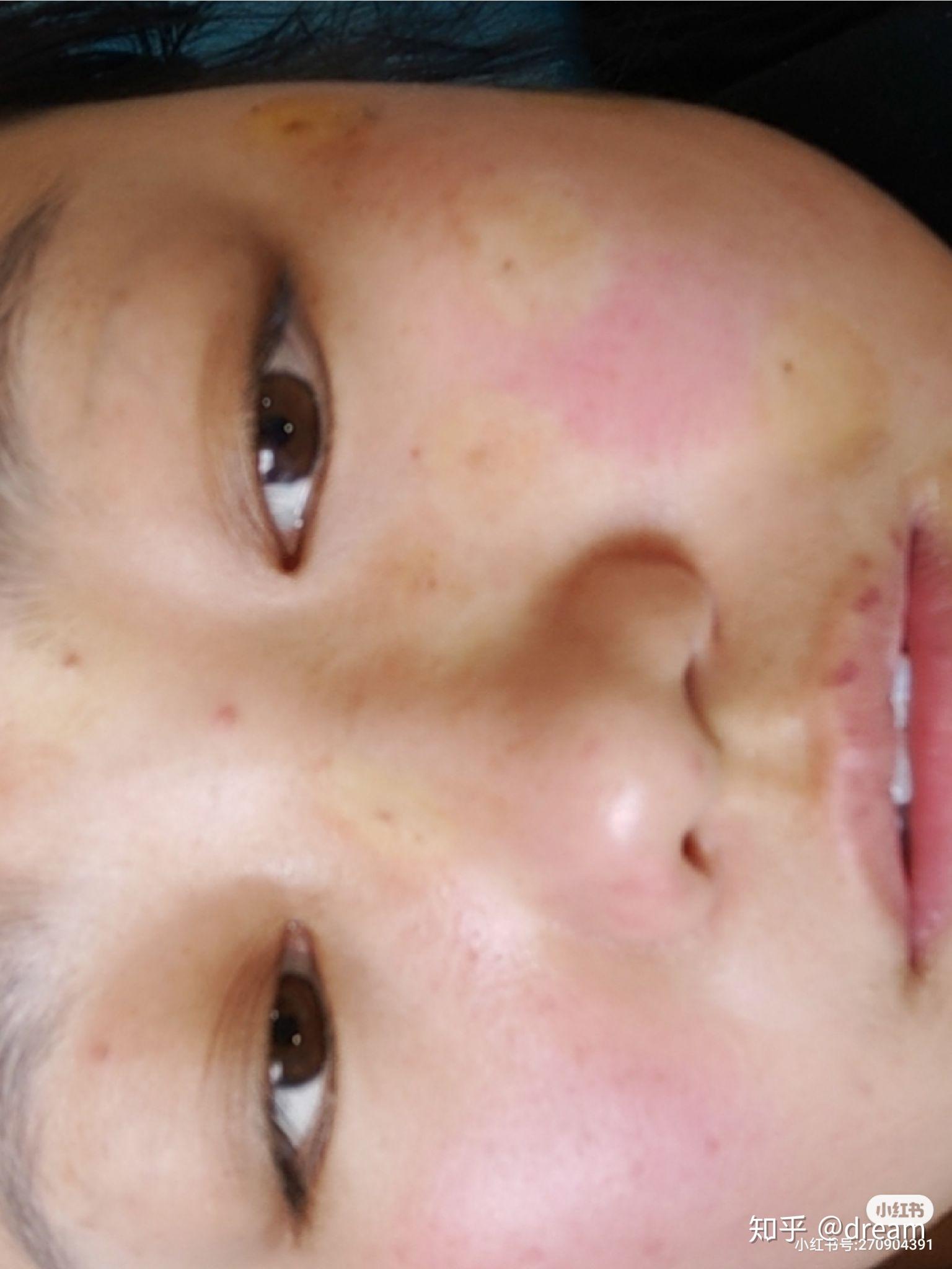 环钻祛痣做完了超皮秒注射水光针环钻祛痣