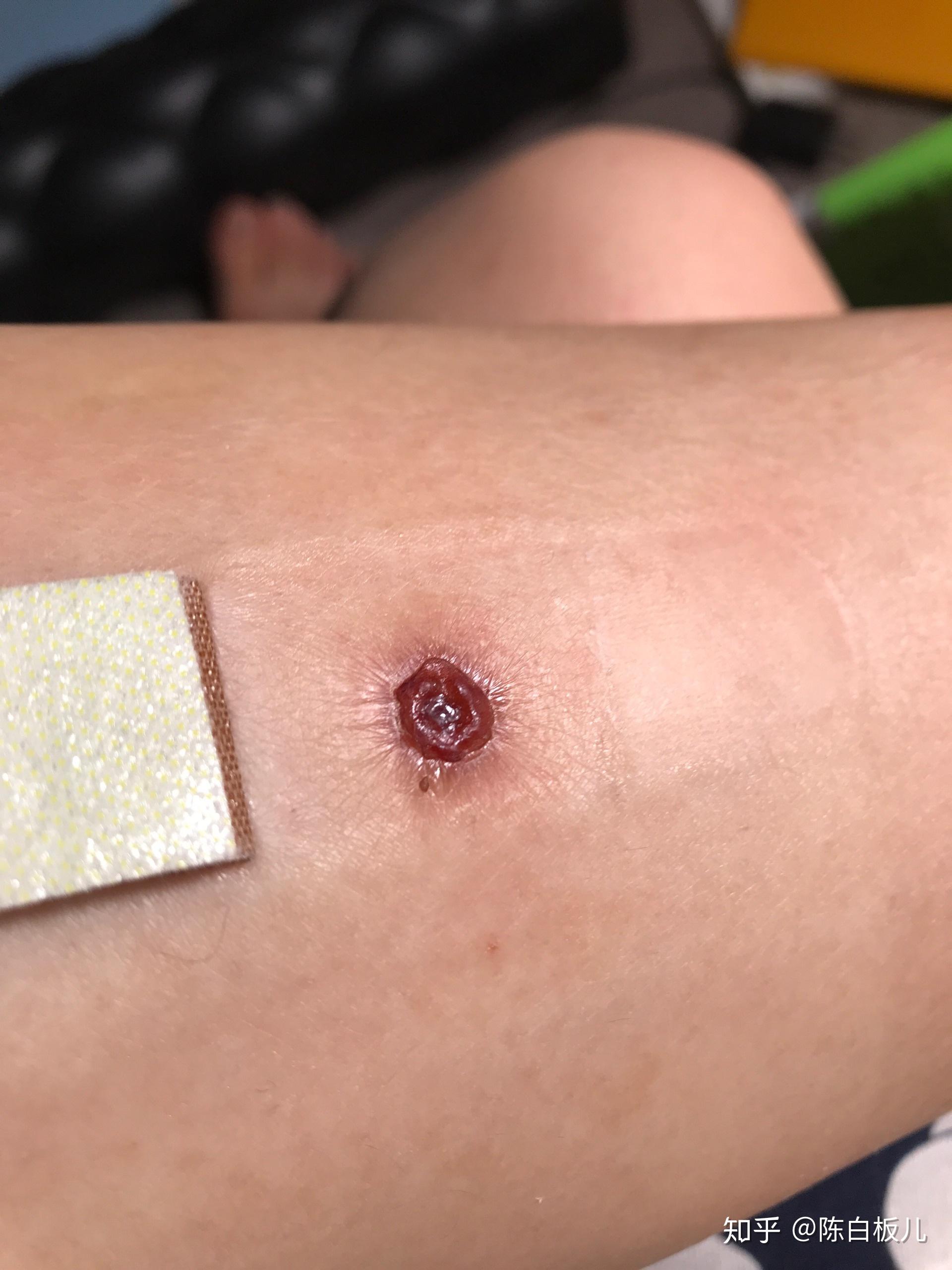 激光祛疣后如何避免留疤