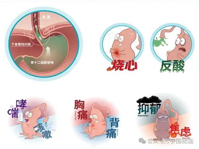 为了更好地科普胃食管反流病，章鱼医生请来了吴继敏主任 - 知乎