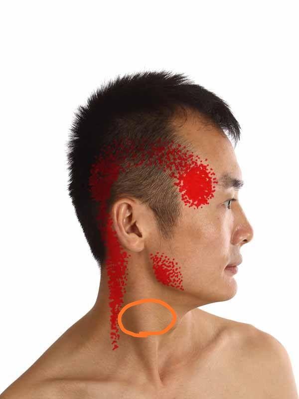 被割断颈动脉之后该如何紧急自救?