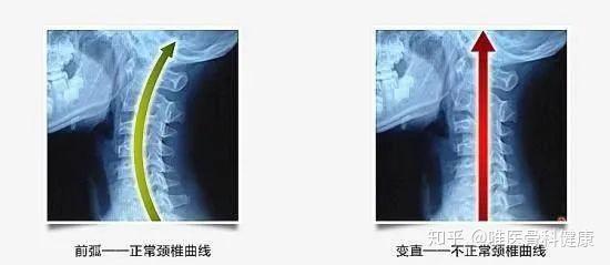 军训攻略 | 又逢一年军训季，骨科医生与您聊聊“站军姿”那些事儿 - 知乎