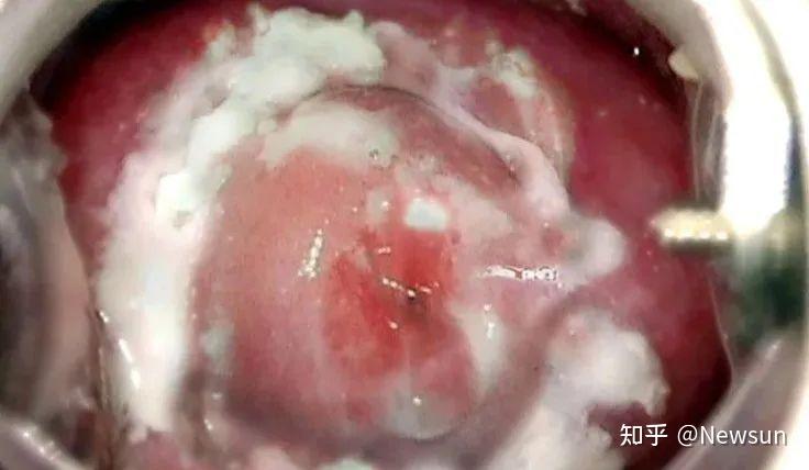hpv,hsv)等作用 收录于·女性健康 16人赞同了该文章 当白带发黄,变