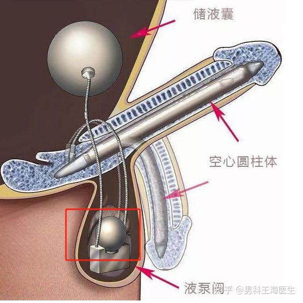 男科假体植入图片图片