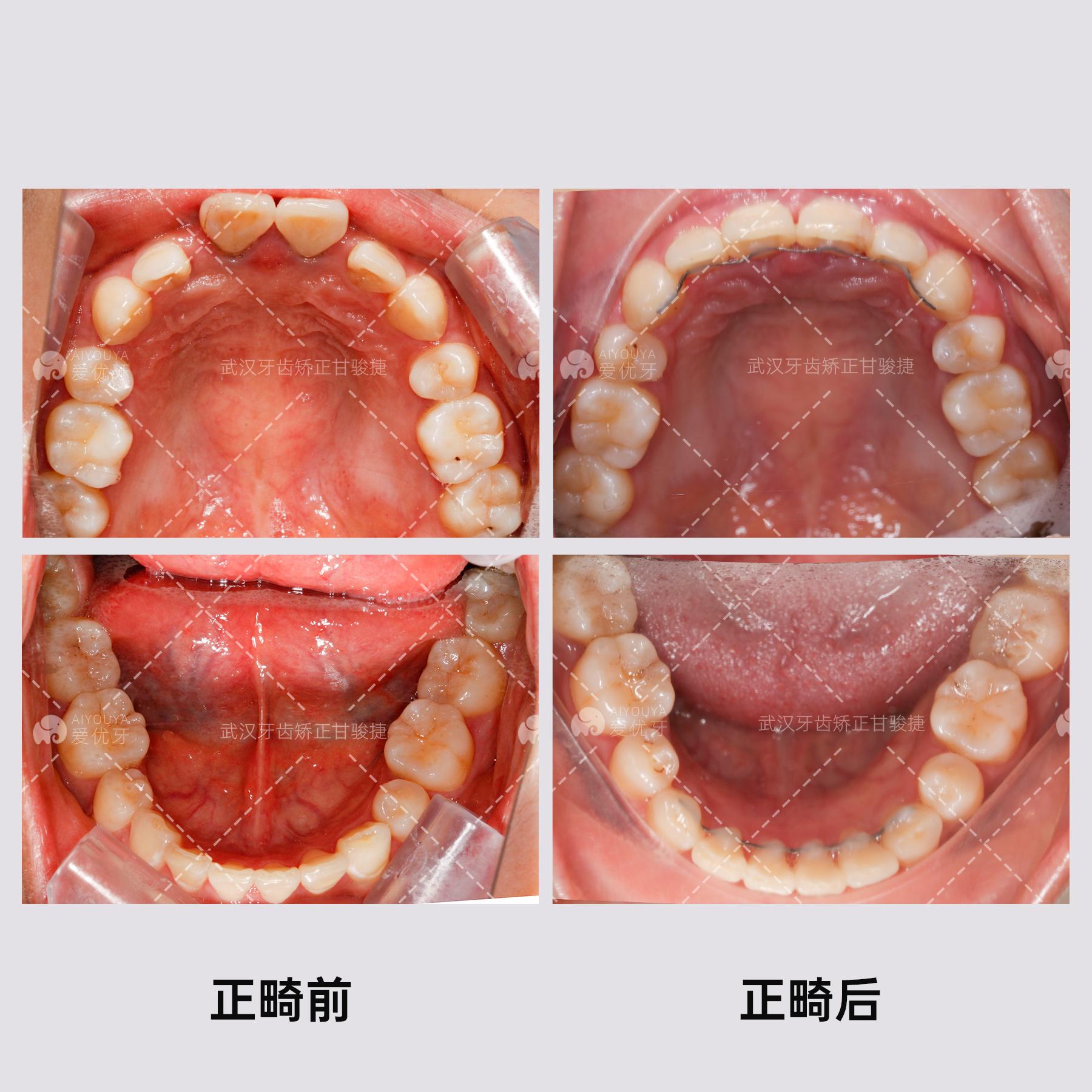 深覆合矫正脸型图片