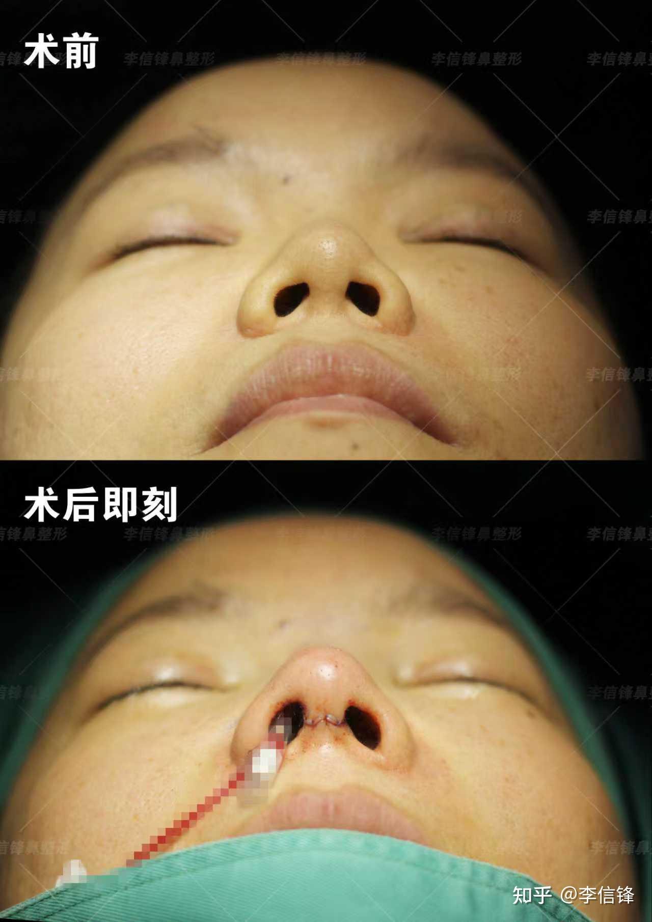 鼻子短、朝天漏鼻孔,鼻基底凹陷改善,术后即刻案例~ - 知乎