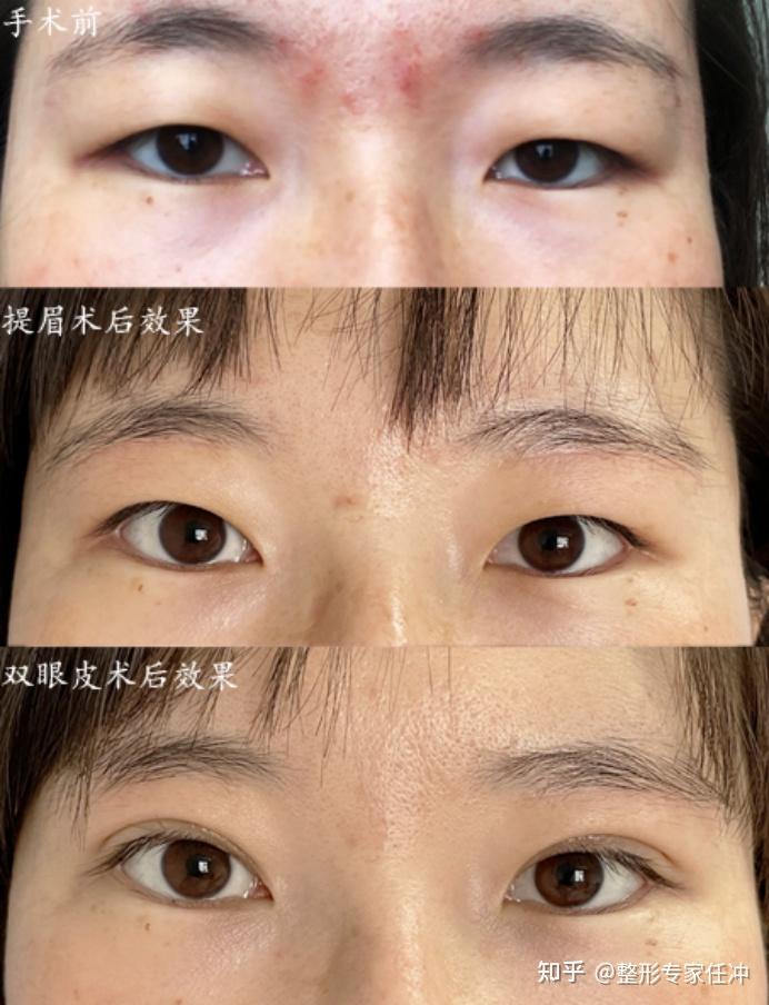 让她自卑多年的肿眼泡做完双眼皮后简直太美了
