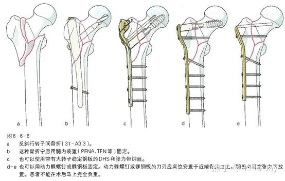 股骨近端骨折的治療原則