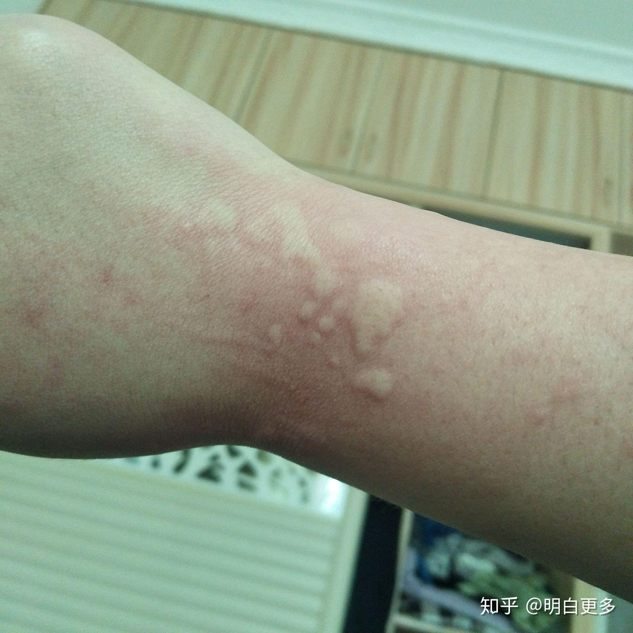 救救我吧荨麻疹快让我绝望了