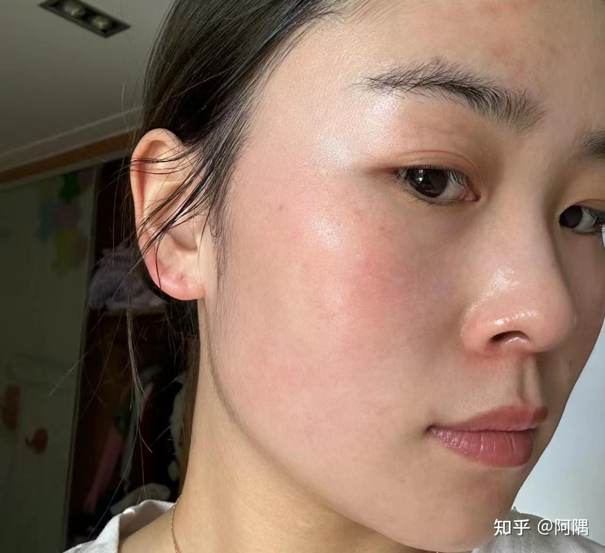 医美后有什么方法可以快速修复受损屏障、泛红敏敏(一次改善不反复的那种)? - 知乎