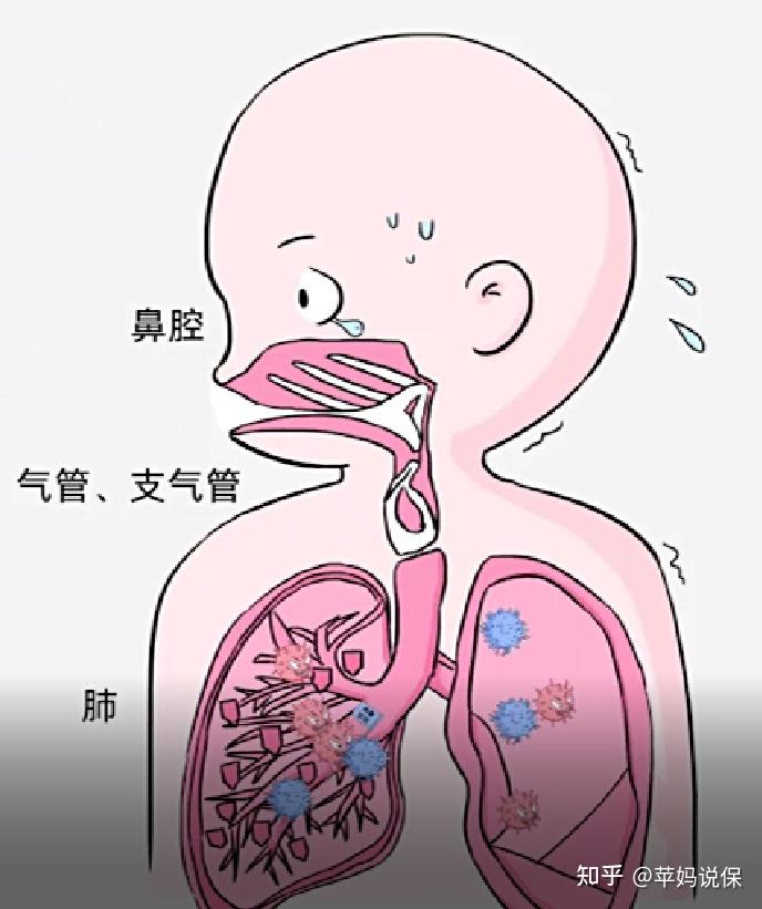 肺炎在新生儿期也是非常高发的,伴随肺气肿,肺不张,新生儿呼吸窘迫