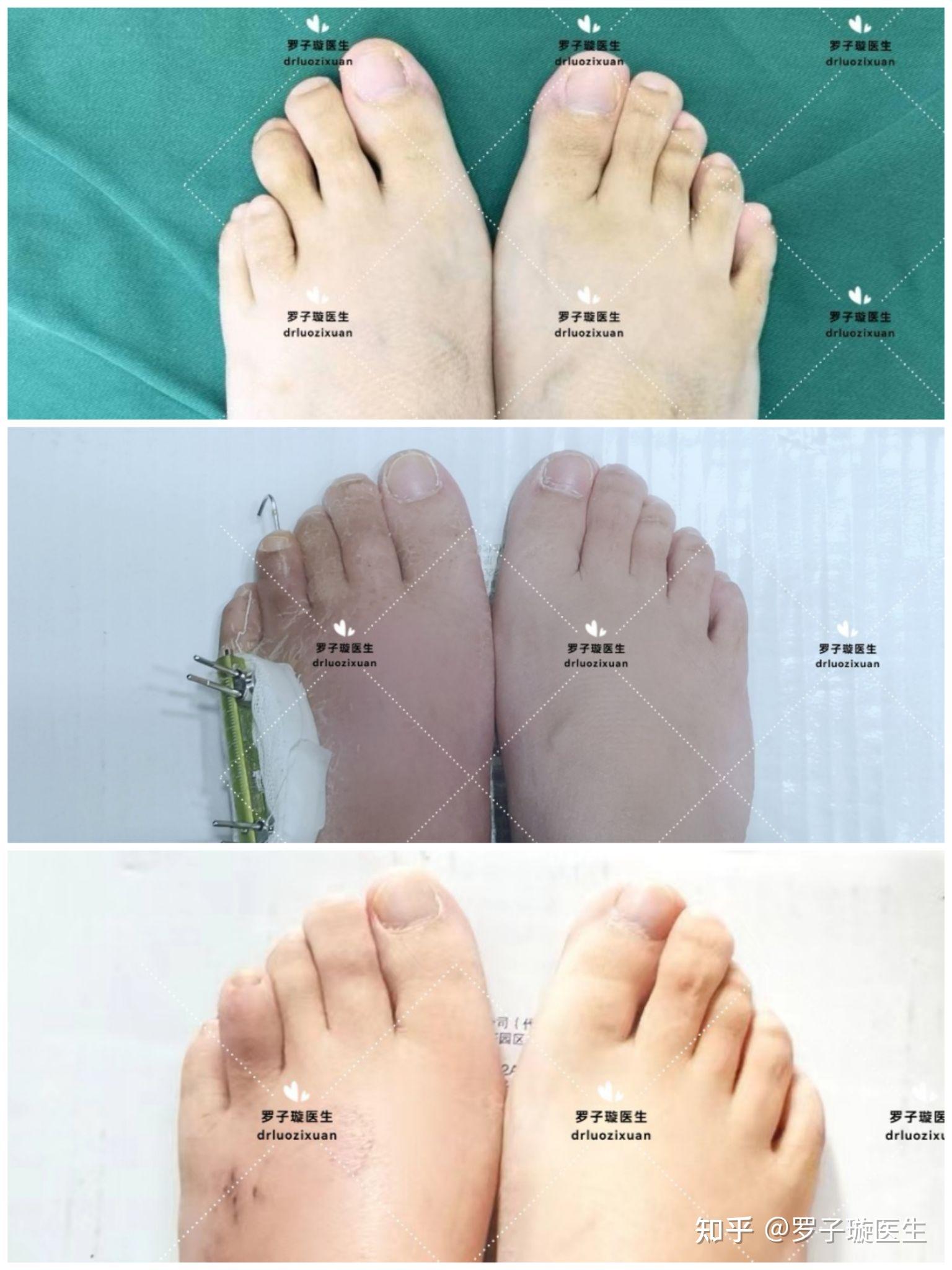 第四脚趾短小症—短趾症—治疗过程 - 知乎
