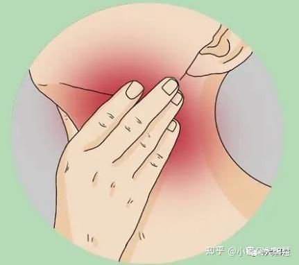 慢性咽炎,中医习称「阴虚喉痹」或「虚火喉痹」,是现在很常见的咽喉病