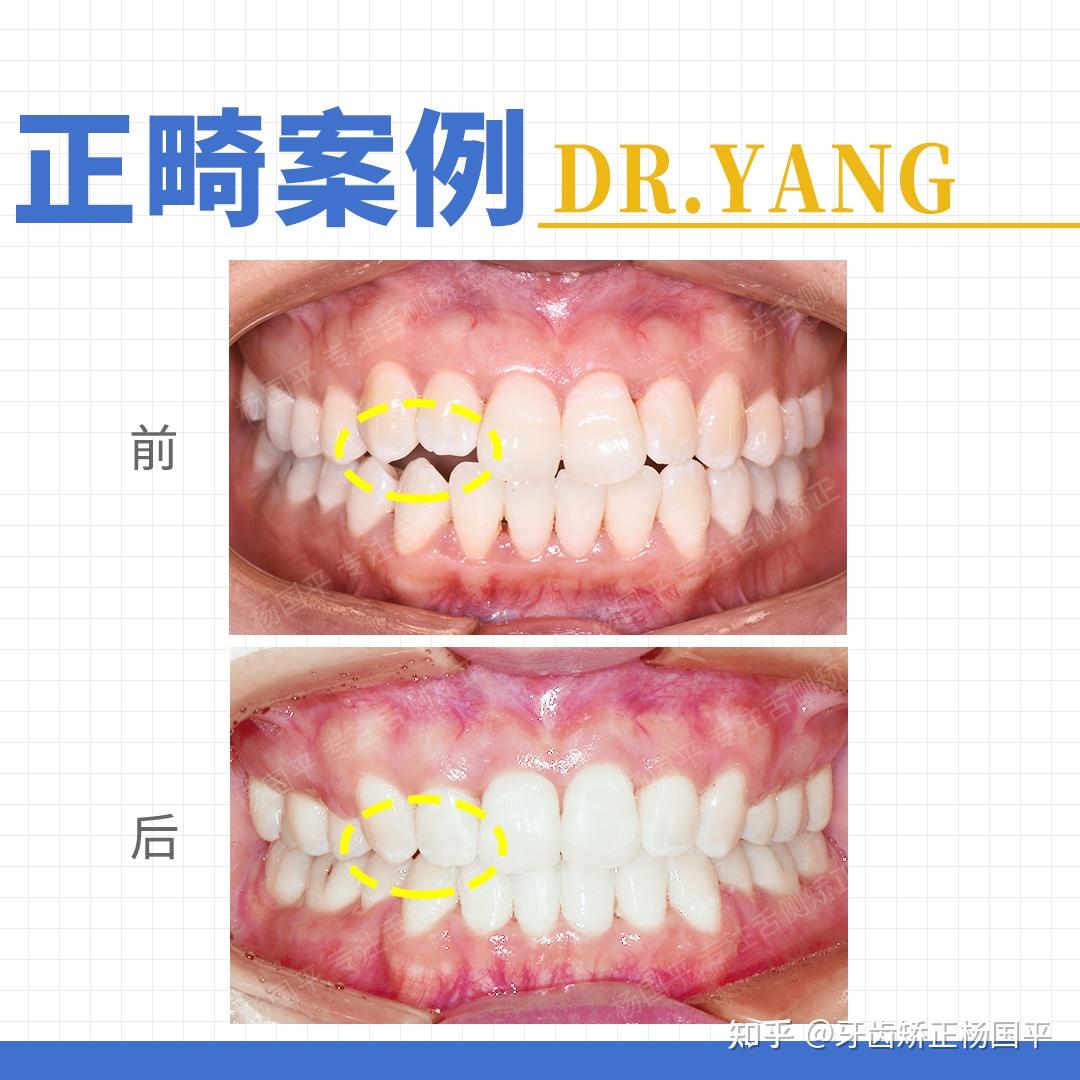 牙周病缺牙患者种牙-王林虎博士的博客-KQ88口腔博客