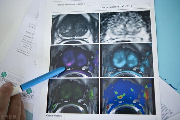 前列腺癌的另一种放疗方式超低分割放疗 知乎