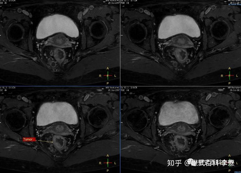 子宫直肠窝无回声区图片