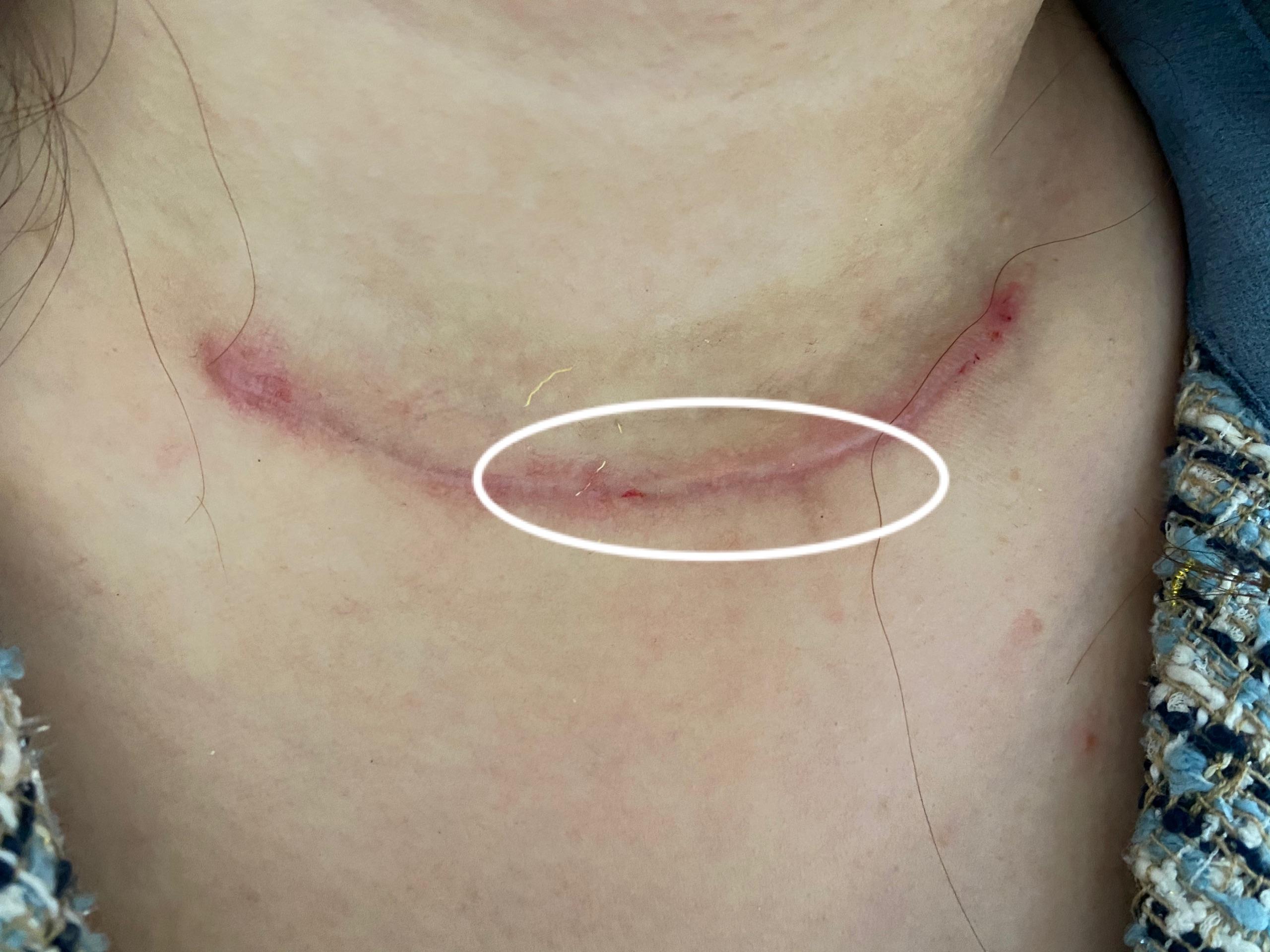 甲状腺结节手术后疤痕图片