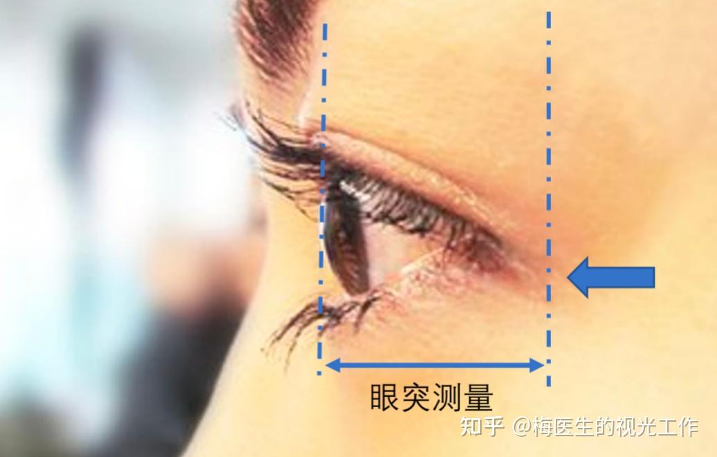 低度近视不用戴眼镜!这个说法是谣言吗? - 知乎