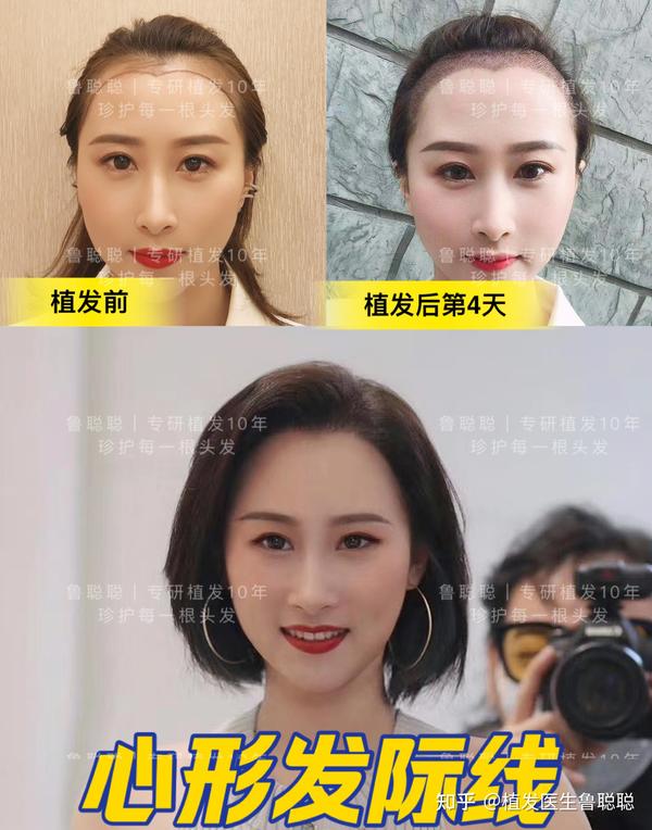 5大发际线样式,你的脸型适合哪个? - 知乎