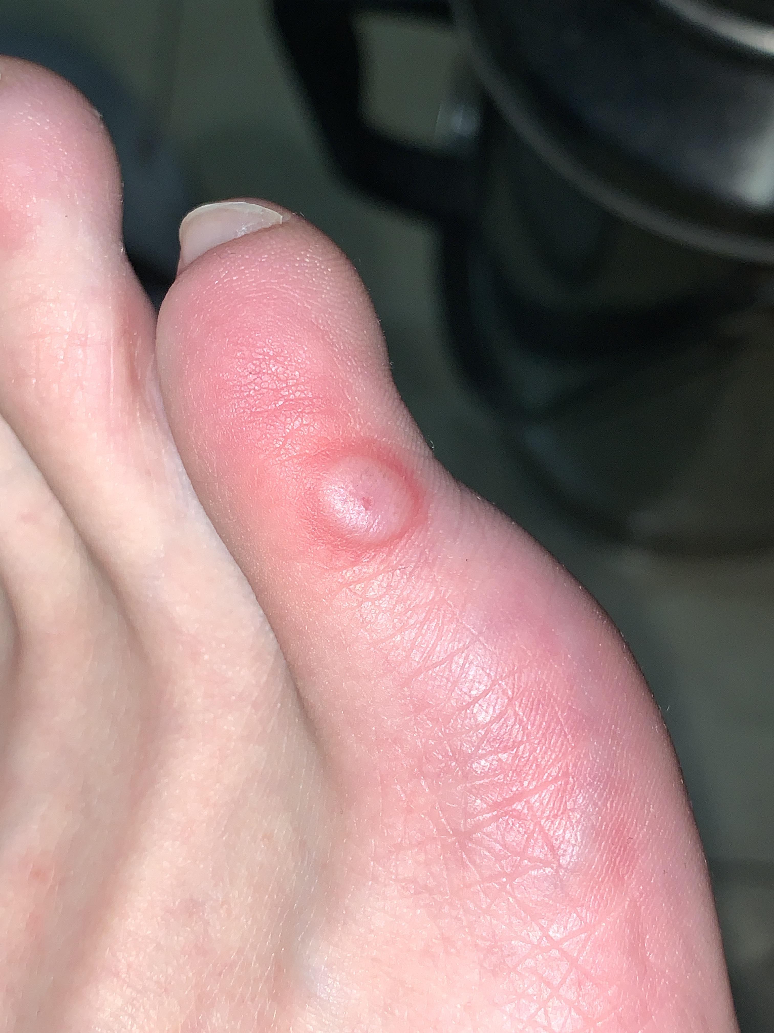 冷冻跖疣过程记录