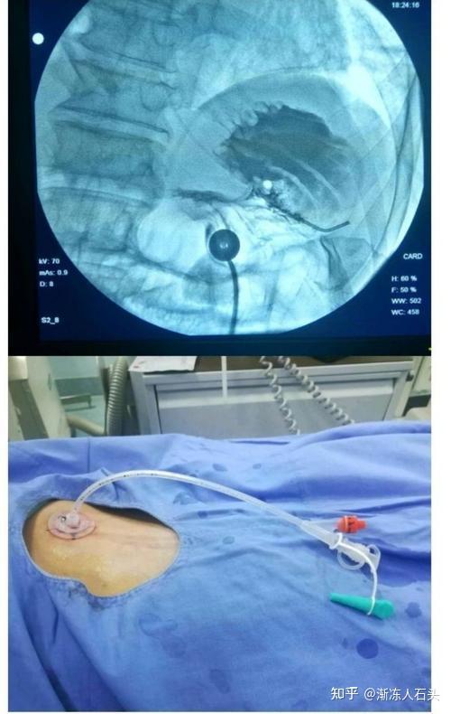 食道癌胃造瘘图片图片