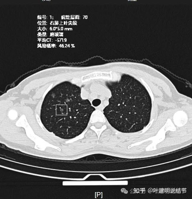 小叶中心结节示意图图片