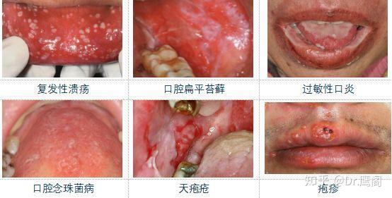 出现口腔黏膜疾病如何处理?