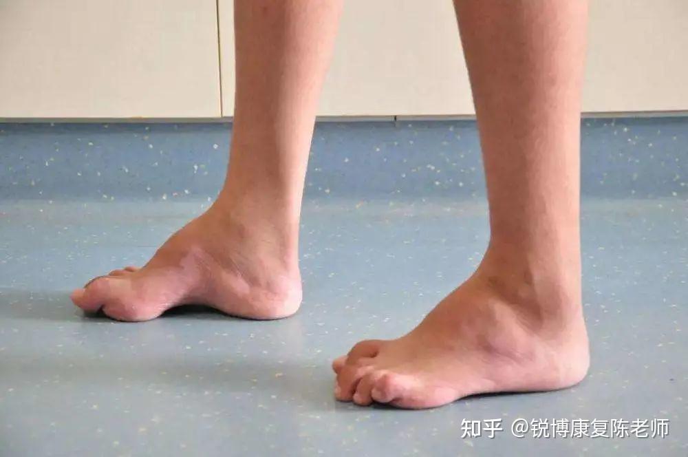 扁平足伤踝伤膝但足弓越高就越稳吗