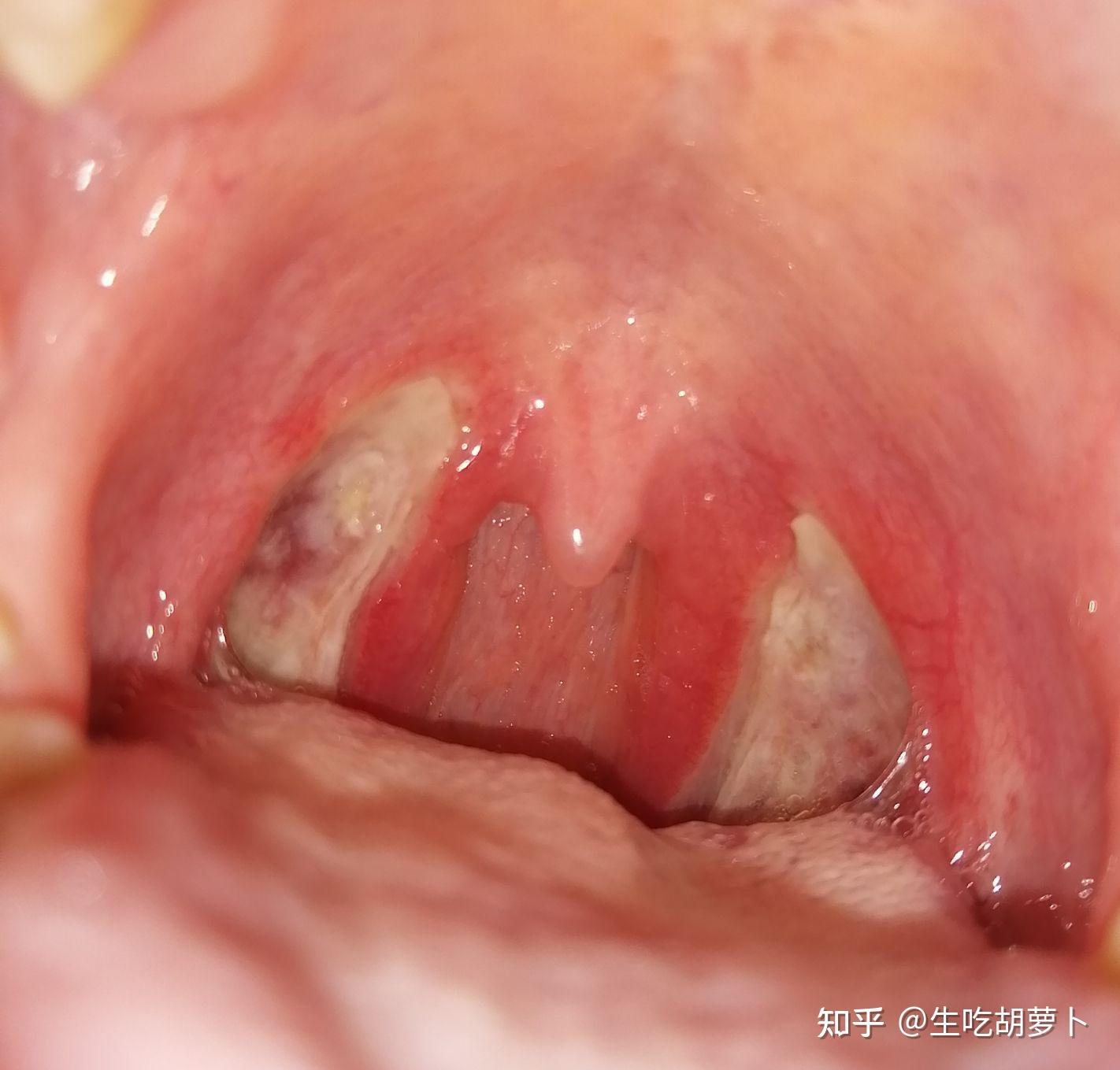 扁桃体鳞状细胞癌图片图片