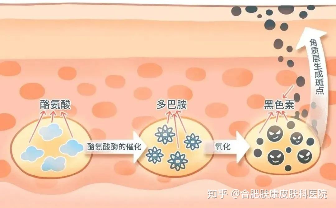激光祛黄褐斑应用「选择性光热作用原理」,瞬间透过皮肤的表皮,到达