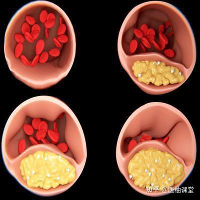 血管内溶血＆血管外溶血：教你一招轻松区别 - 知乎