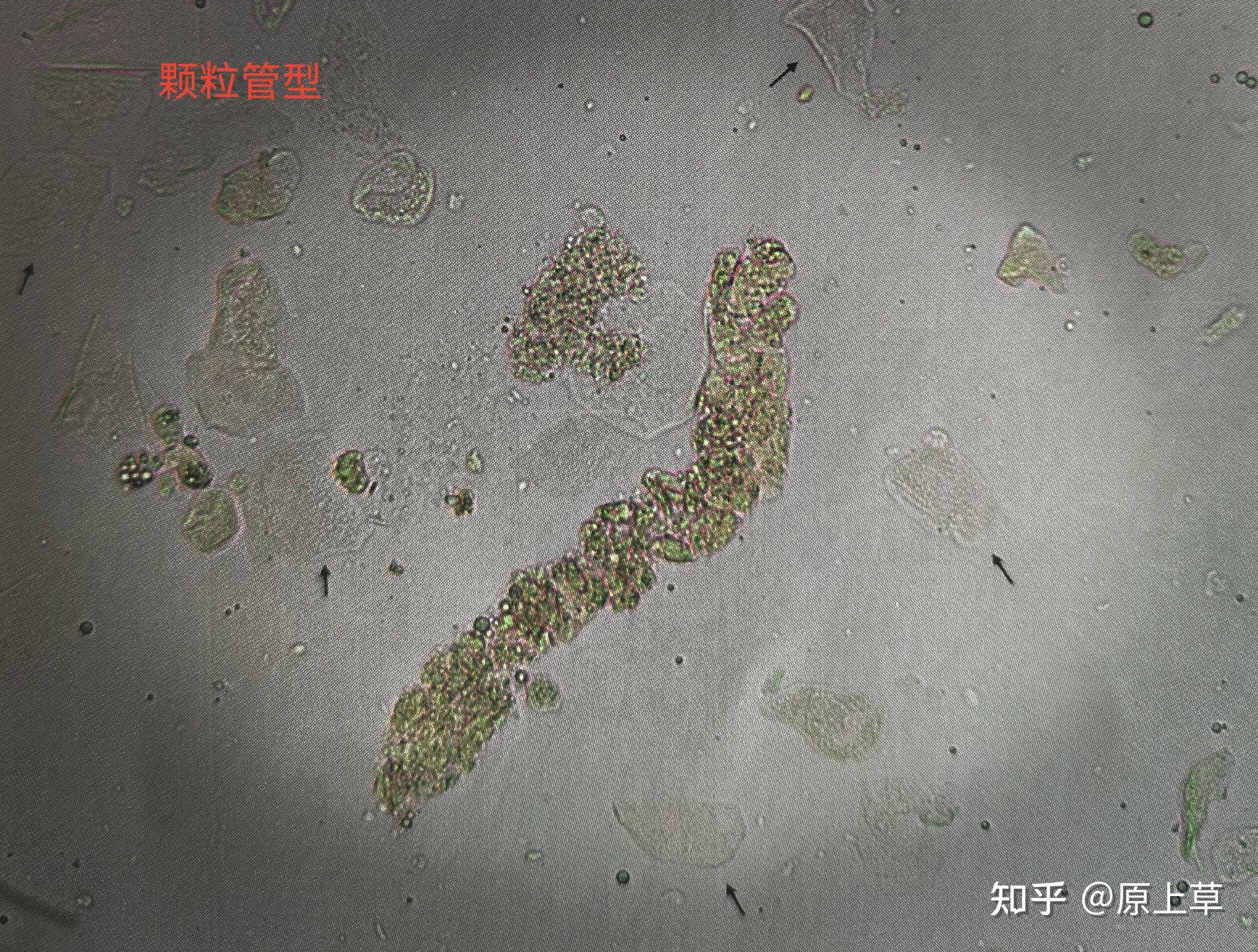 颗粒管型和细颗粒管型在尿沉渣中较常见