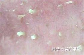 角栓是什么?鼻头毛孔里的白芯到底是什么? - 知乎
