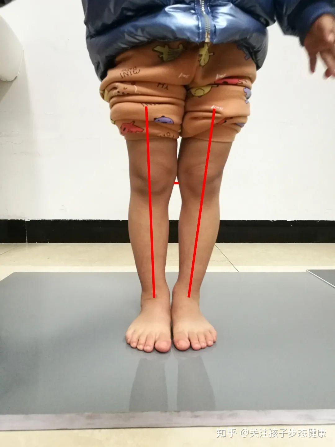 五个瑜伽体式，帮你矫正O型腿 - 知乎