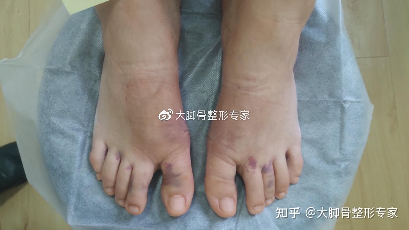 做大腳骨手術一定要上鋼板嗎微創效果佳恢復快