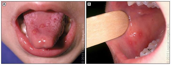 手足口病的舌头图片图片