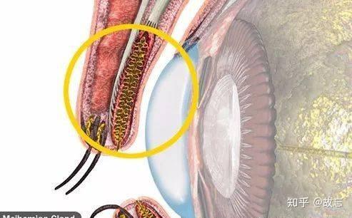 你眼睛的痛睑板腺来担