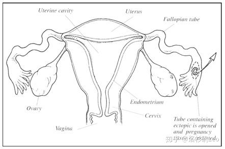 宫外孕怎么办 关于宫外孕的诊断和治疗 知乎
