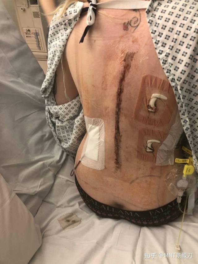 物理康复矫正脊柱侧弯效果到底怎么样