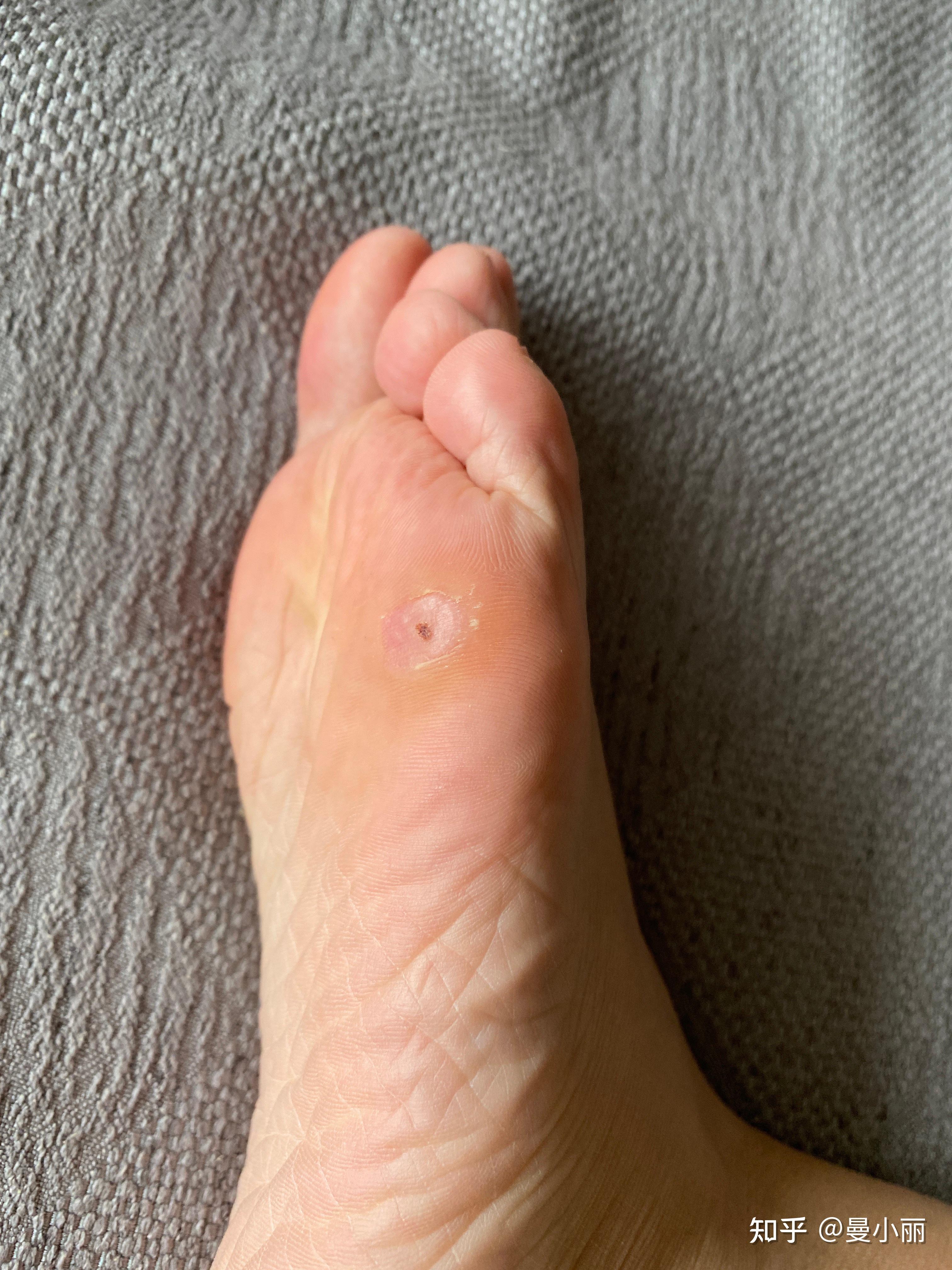 酷刑之冷冻跖疣