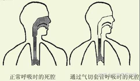气切术后选择合适直径的套管,可有效减少呼吸道死腔约50%,降低了气道