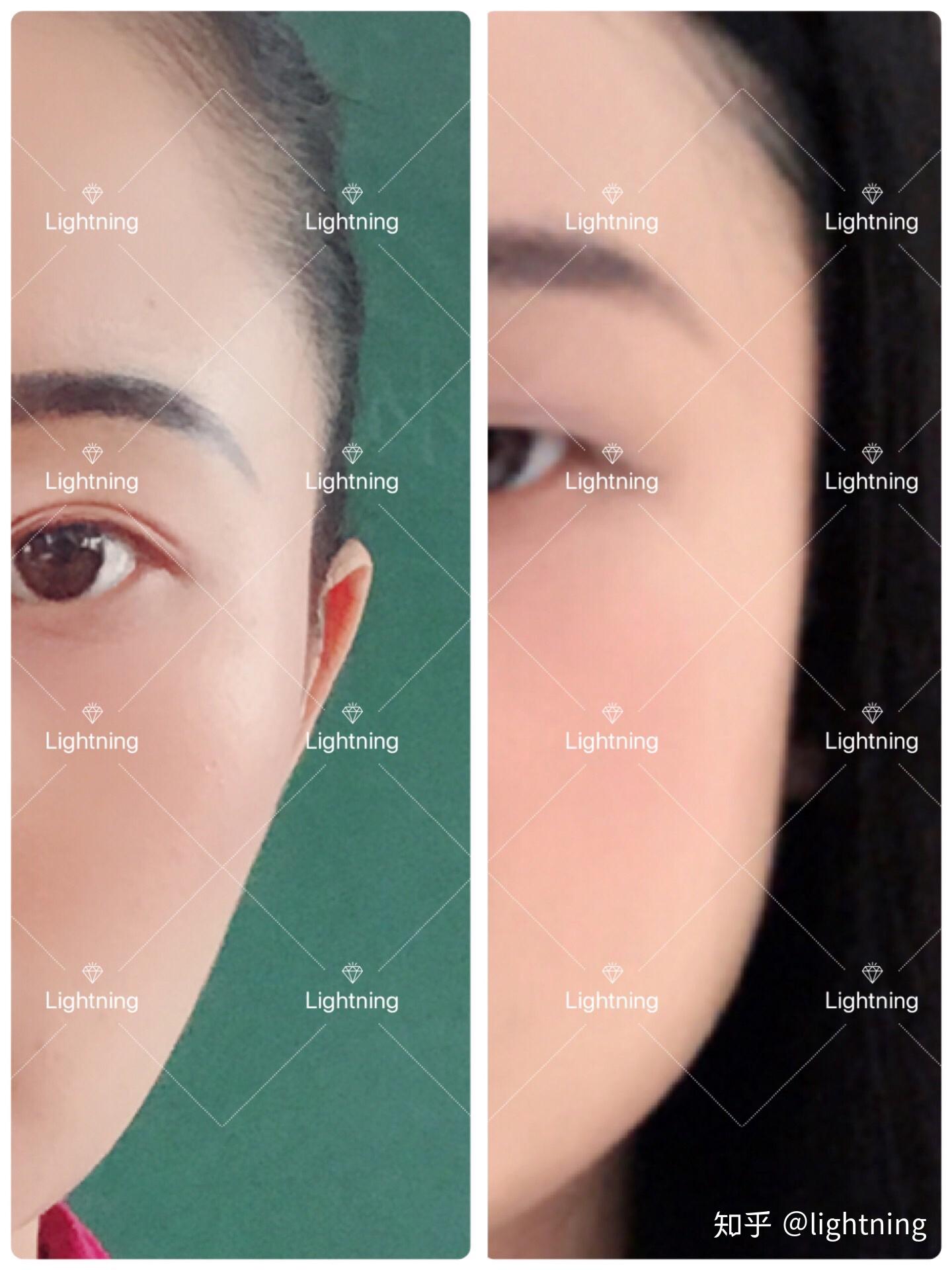 打瘦脸针失败了,脸颊凹陷成了葫芦脸,现在的我