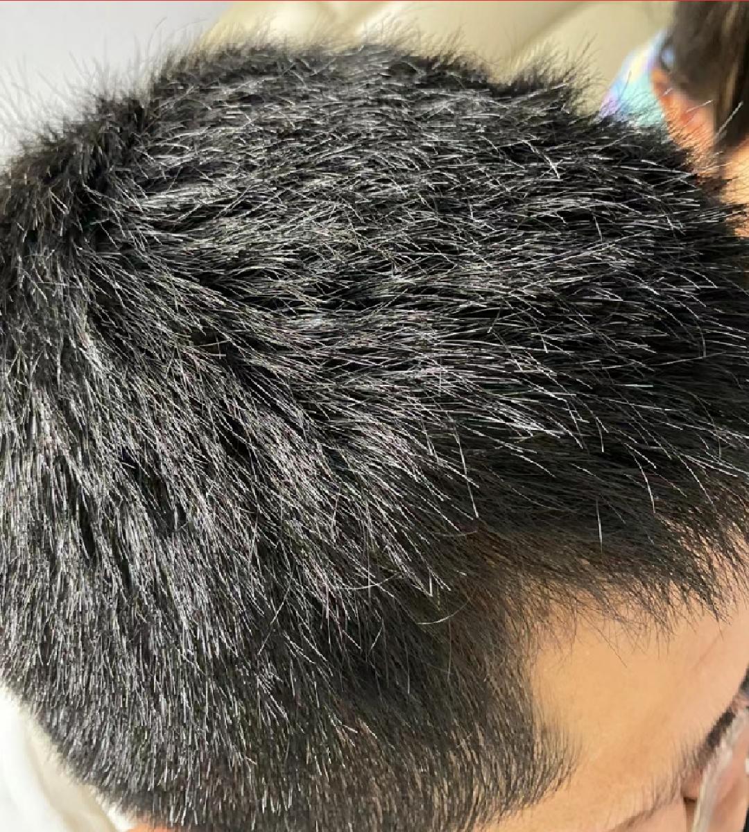 【医学硕士】教你3步解决男士脱发问题,2个月有效防脱发,解救那些被