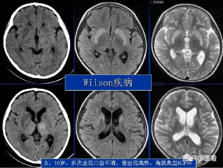 基底节ct图片