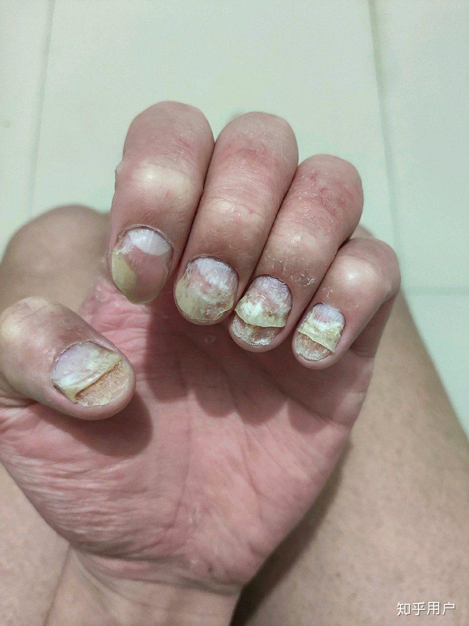 伊曲康唑治疗灰指甲多久见效