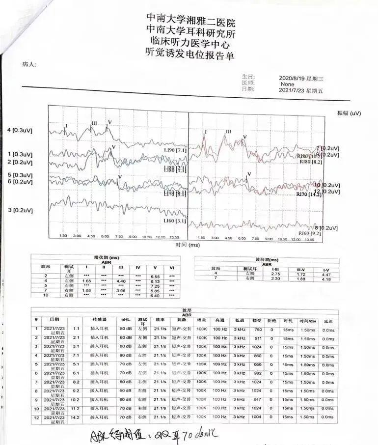 听觉脑干诱发电位(click-abr 气导阈值)结果显示:双耳均未引出dpoae为