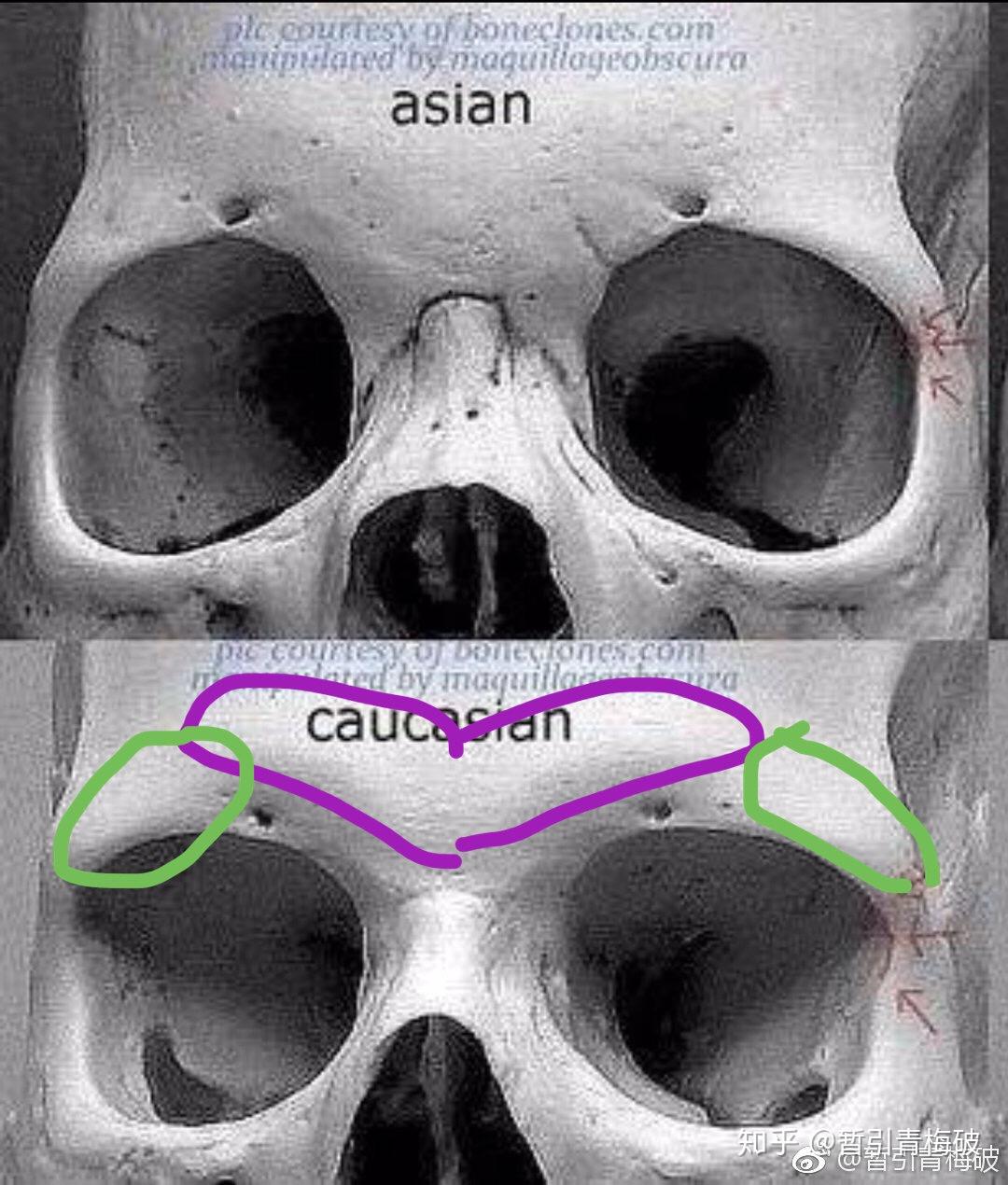 在这里想让大家注目的是欧洲人眉心的v形骨骼(紫色标注),和后眼眶骨