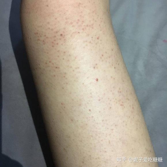 空乘腿上有鸡皮肤(腿上有鸡皮可以考空乘吗)