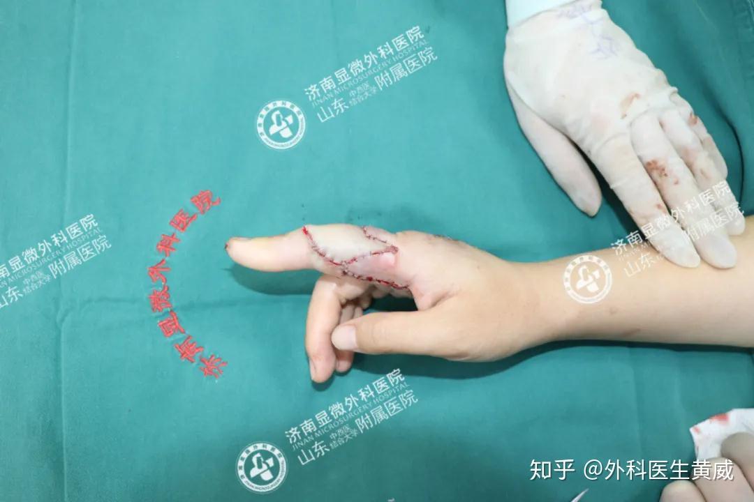 机械挤伤食指致严重缺损3d全形手指再造术完美复原