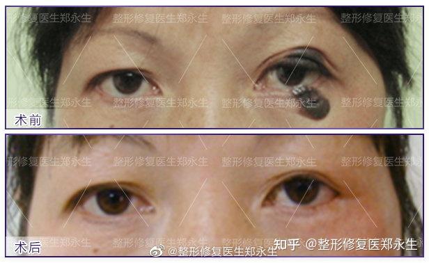 眼睑分裂痣的治疗原则