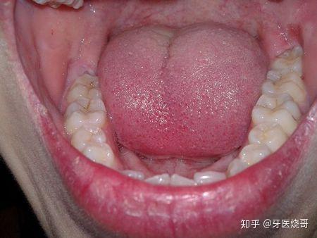牙龈盲袋图图片